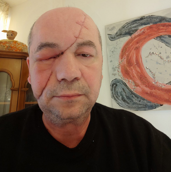 Мариуполец, потерявший глаз и семью из-за российских обстрелов - Life