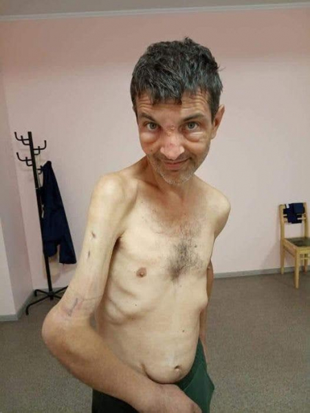 Сестра морпеха Дианова о его состоянии после плена: не хватает 30% веса и 4 сантиметров кости - Life